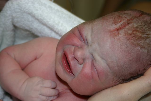 Cameron with his battle wound